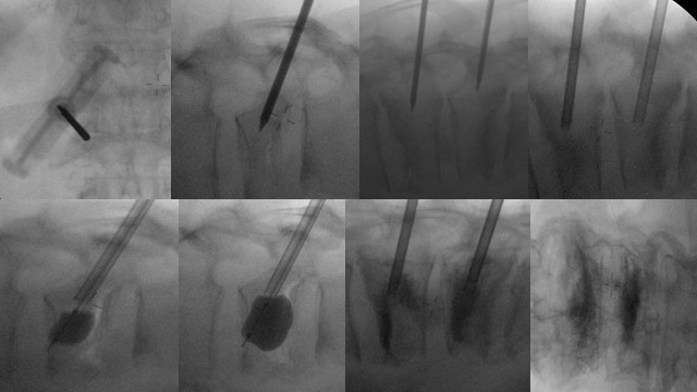 Demonstration of all stages of Balloon Kyphoplasty via
fluoroscopy.