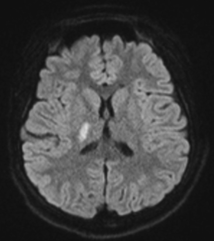Brain magnetic resonance imaging revealed an area of restricted
diffusion over the right globus pallidus.