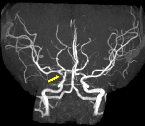 Magnetic resonance angiography revealed narrowing of the
supraclinoid portion of the right internal carotid artery (yellow arrow).