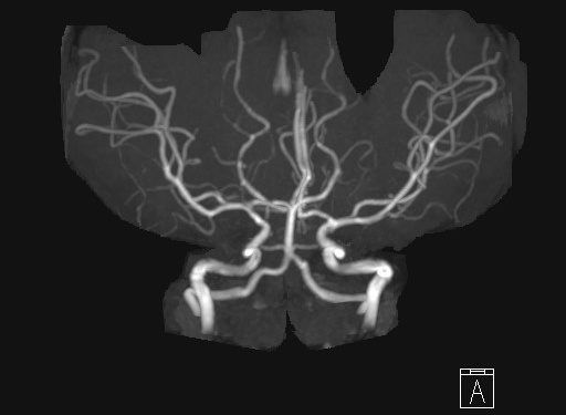 Brain MRA 4 months after discharge from the hospital revealed
that cerebral arteriopathy had resolved.