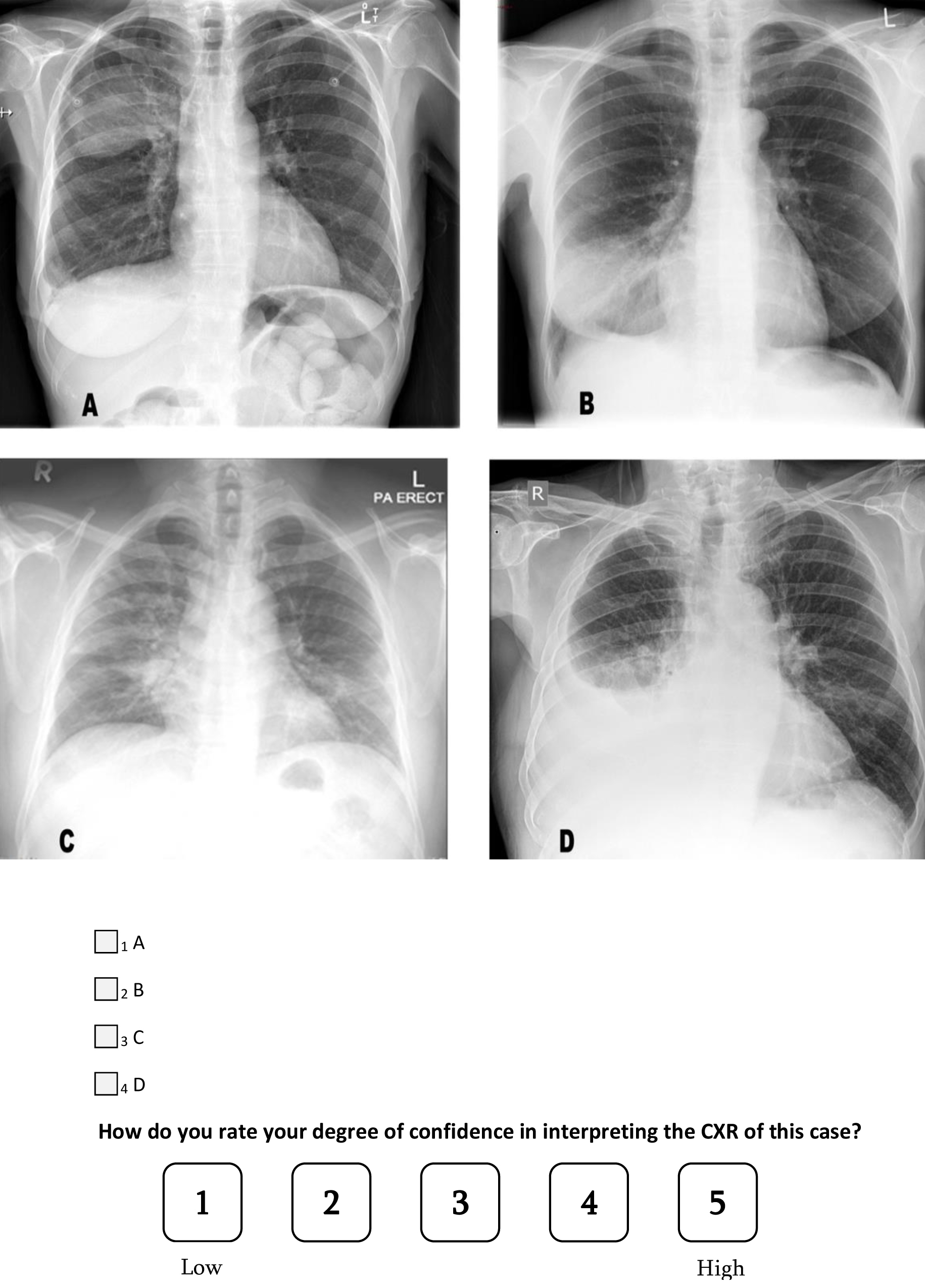 A question from the survey on COVID-19 pneumonia. CXR: chest
X-ray.