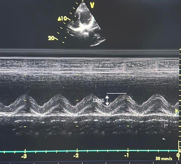 TTE image of TAPSE. TAPSE: tricuspid annular plane systolic excursion.
