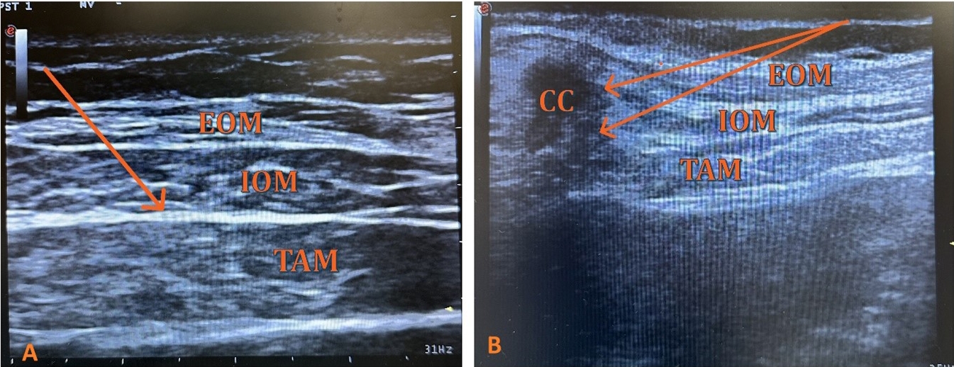 Ultrasonographic image of TAP and TAPA blocks. Local
anesthetic injection sites for TAP (A) and TAPA (B) blocks. CC: costal cartilage;
EOM: external oblique muscle; IOM: internal oblique muscle; TAM: transversus
abdominis muscle.