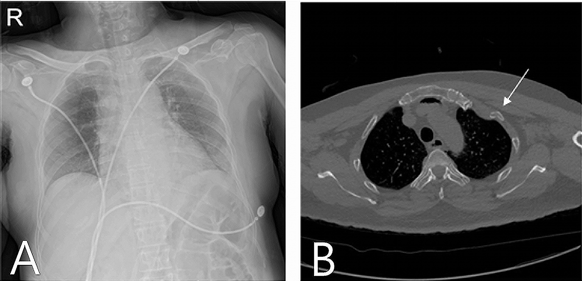 Initial imaging findings following blunt chest trauma. (A) The 
chest radiograph did not demonstrate acute intrathoracic injury. (B) Chest 
computed tomography showed a left second rib fracture.