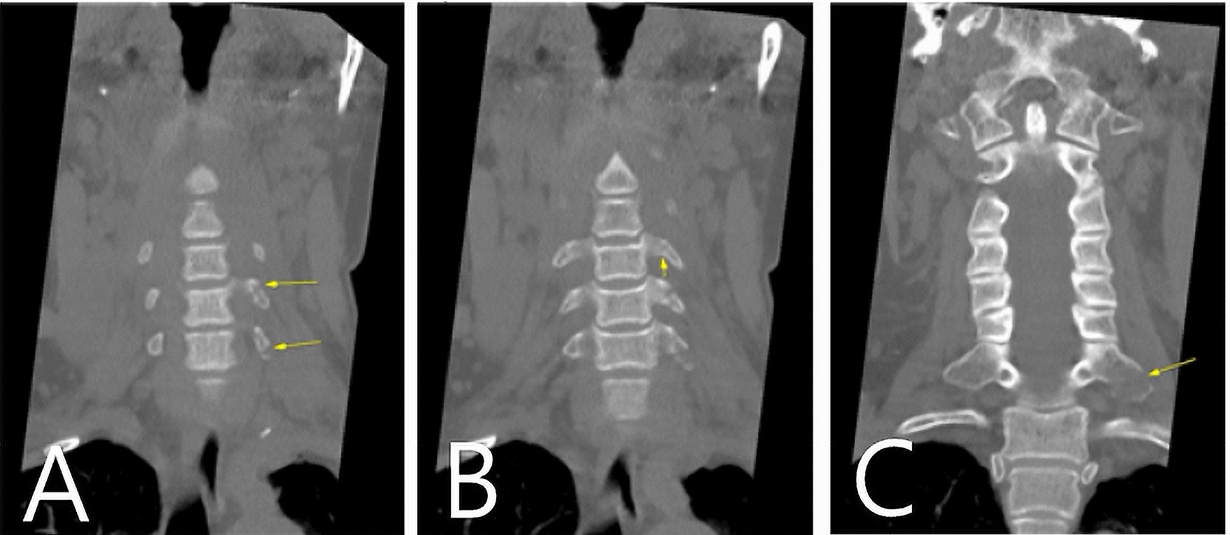 Cervical spine computed tomography in coronal view. (A) Left 
C5–C6 transverse process fractures (arrows indicate the fracture sites). (B) 
Left C4 transverse process fracture (arrow). (C) Left C7 transverse process 
fracture (arrow).