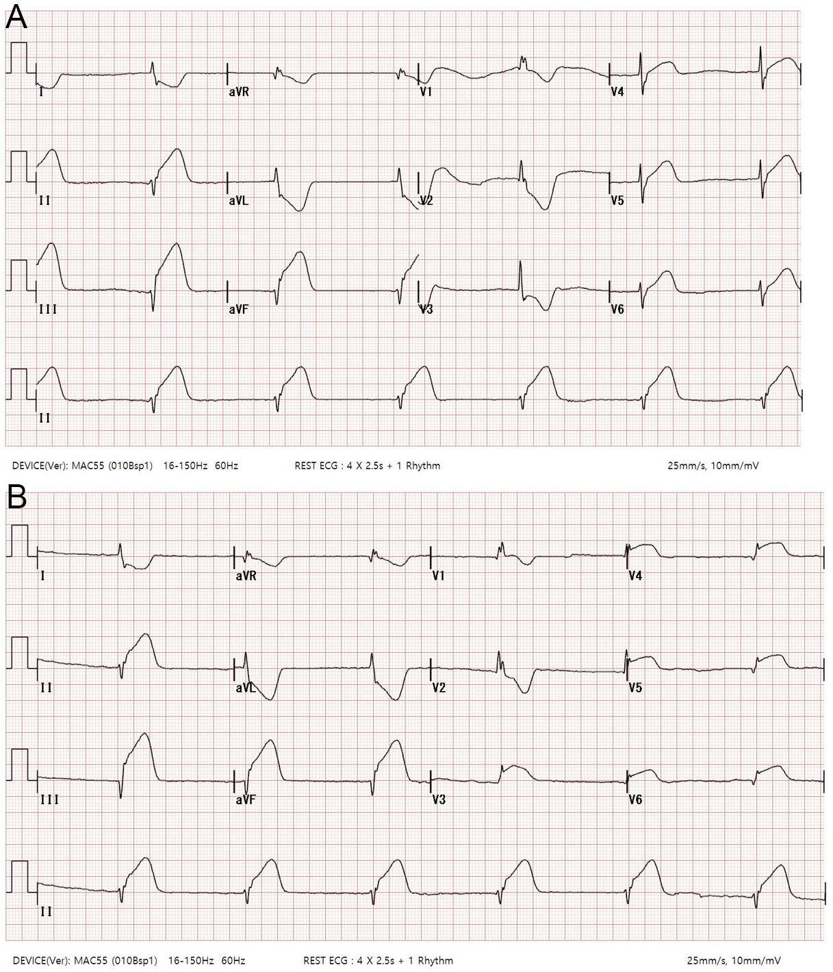 Electrocardiographic findings. (A) Electrocardiogram showing 
diffuse inferior wall ST-segment elevation. (B) Inverted electrocardiogram 
showing ST-segment elevation in leads V4–6. aVR: augmented Voltage Right lead; 
aVL: augmented Voltage Left lead; aVF: augmented Voltage Foot lead; ECG: 
Electrocardiogram.