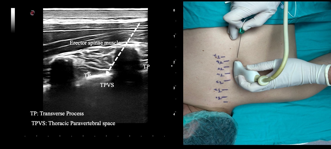 Application of the TPVB and an ultrasound image.