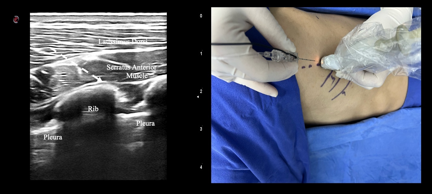 Application of the SAPB and an ultrasound image.
