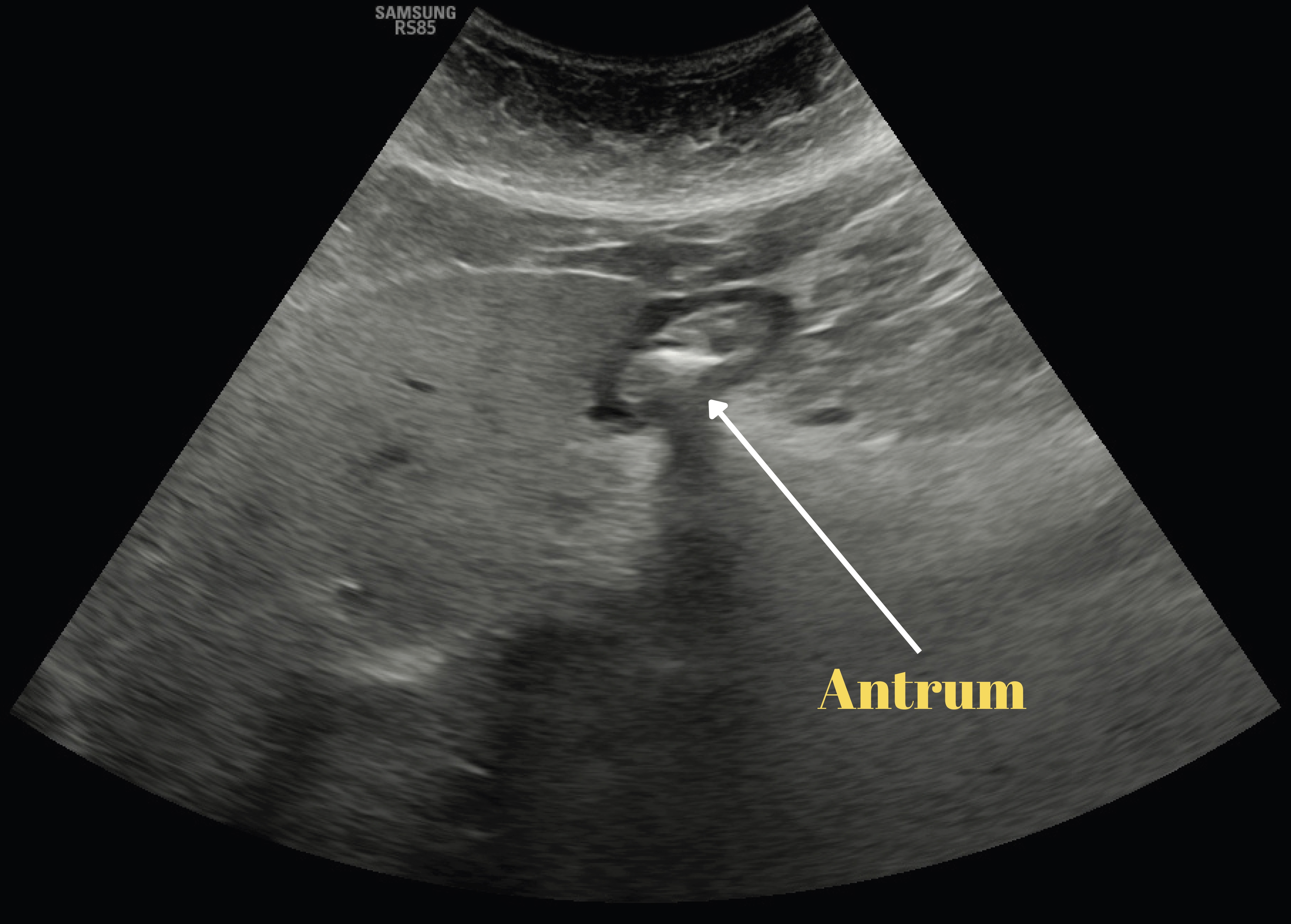 Ultrasound image of the gastric antrum in the right lateral 
decubitus position. Representative image of the gastric antrum obtained via 
ultrasonography, demonstrating the anatomical borders of the antrum in the right 
lateral decubitus position.
