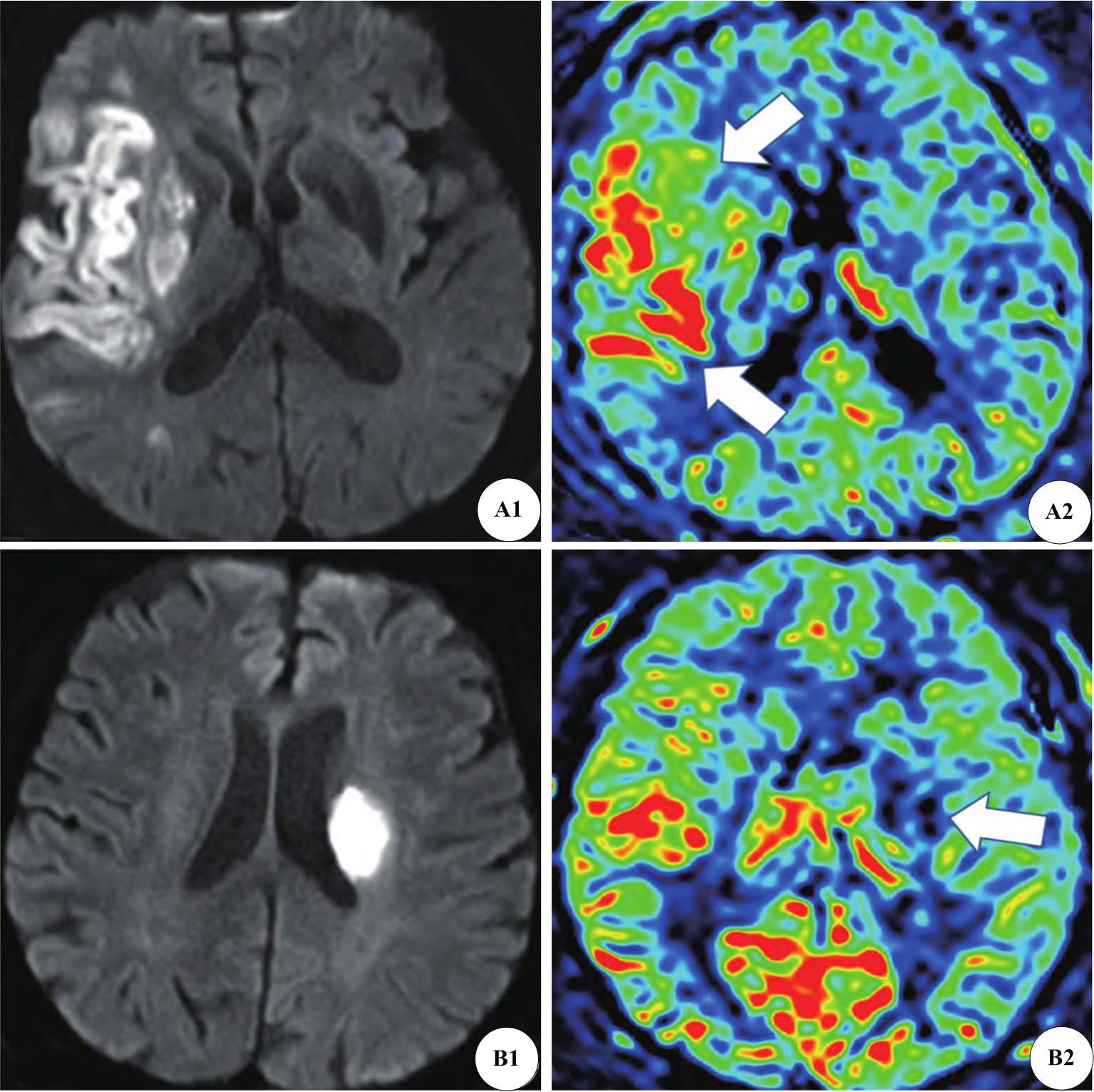 3D-ASL perfusion status (PLD = 2500 ms) under different
prognostic conditions. (A1) DWI image of a patient with poor prognosis. (A2) DWI
image of a patient with good prognosis. (B1) 3D-ASL image (PLD = 2500 ms) of a
patient with poor prognosis (after intravenous thrombolysis). (B2) 3D-ASL image
(PLD = 2500 ms) of a patient with good prognosis.