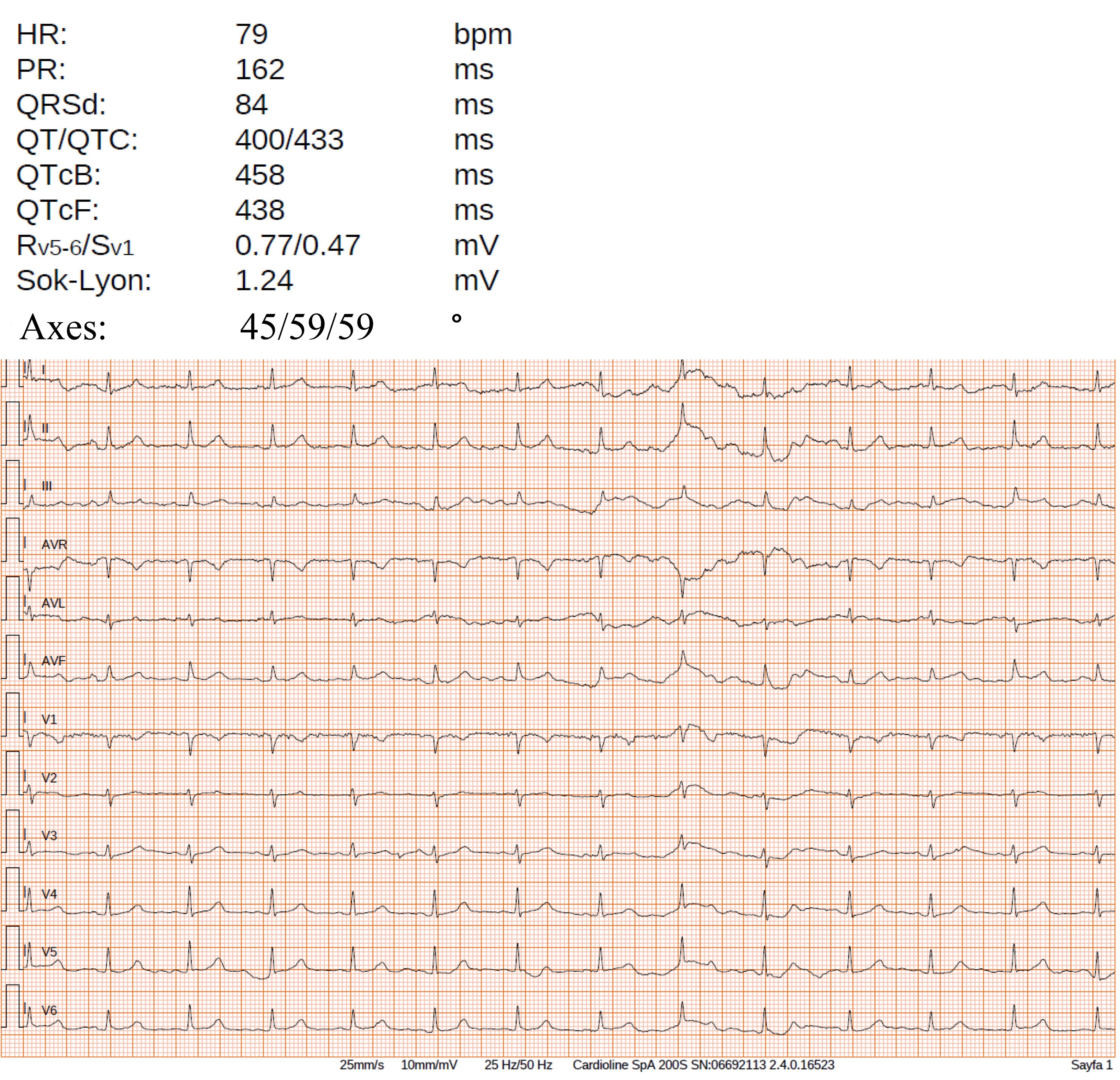 Using ECG device’s report to measure fQRS TA. HR: Heart Rate;
PR: PR Interval; QRSd: QRS Duration; QT: QT Interval; QTC: Corrected QT Interval;
QTcB: Interval Corrected by Bazett’s Formula; QTcF: Interval Corrected by
Fridericia’s Formula; AVR: Augmented Vector Right; AVL: Augmented Vector Left;
AVF: Augmented Vector Foot.