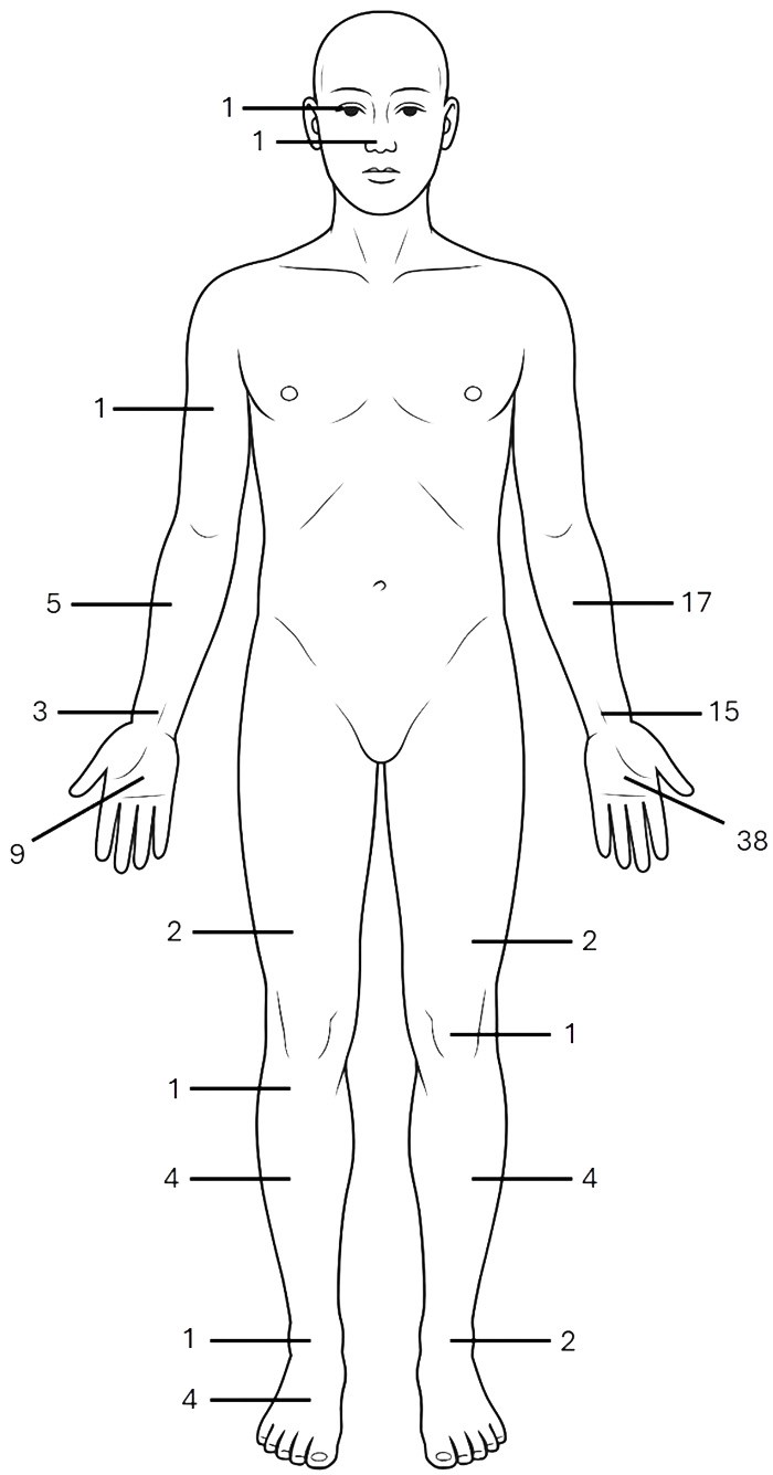 Sites of injuries. Each number represents how many
injuries occurred in that anatomical location.