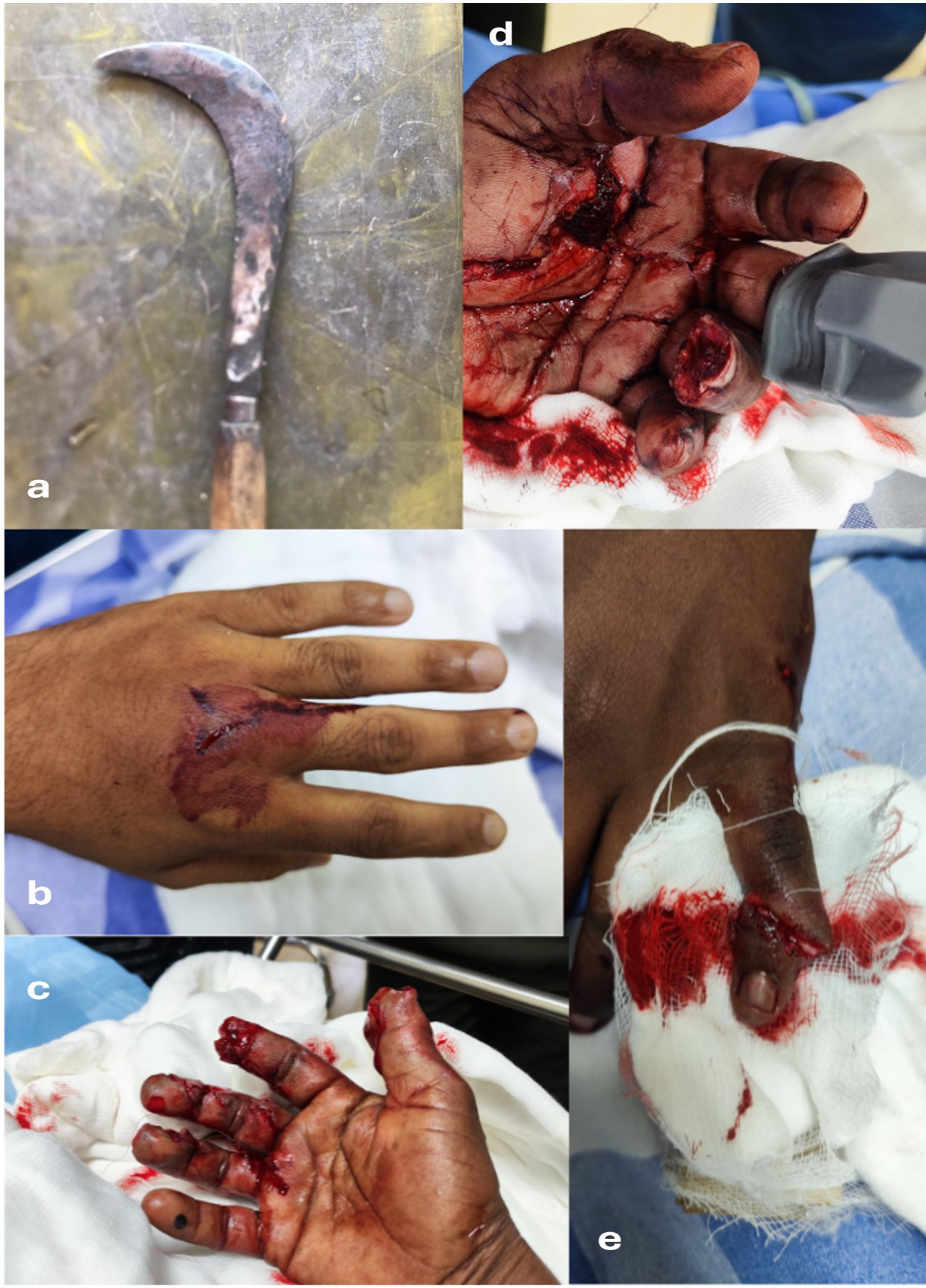 Spectrum of clinical presentations of sickle-related hand
injuries. (a) Regionally used farming sickle. (b) Laceration over the dorsal
surface of the left hand. (c) Complete amputation of the tips of the right thumb
and right index finger, with associated laceration wounds over the right middle
and ring fingers. (d) Palmar aspect of the left hand showing a sickle-cut injury
with a cut lacerated wound over the left thenar eminence and complete amputation
at the distal interphalangeal (DIP) joint of the left ring finger. (e) Complete
amputation of the right little finger at the DIP joint.