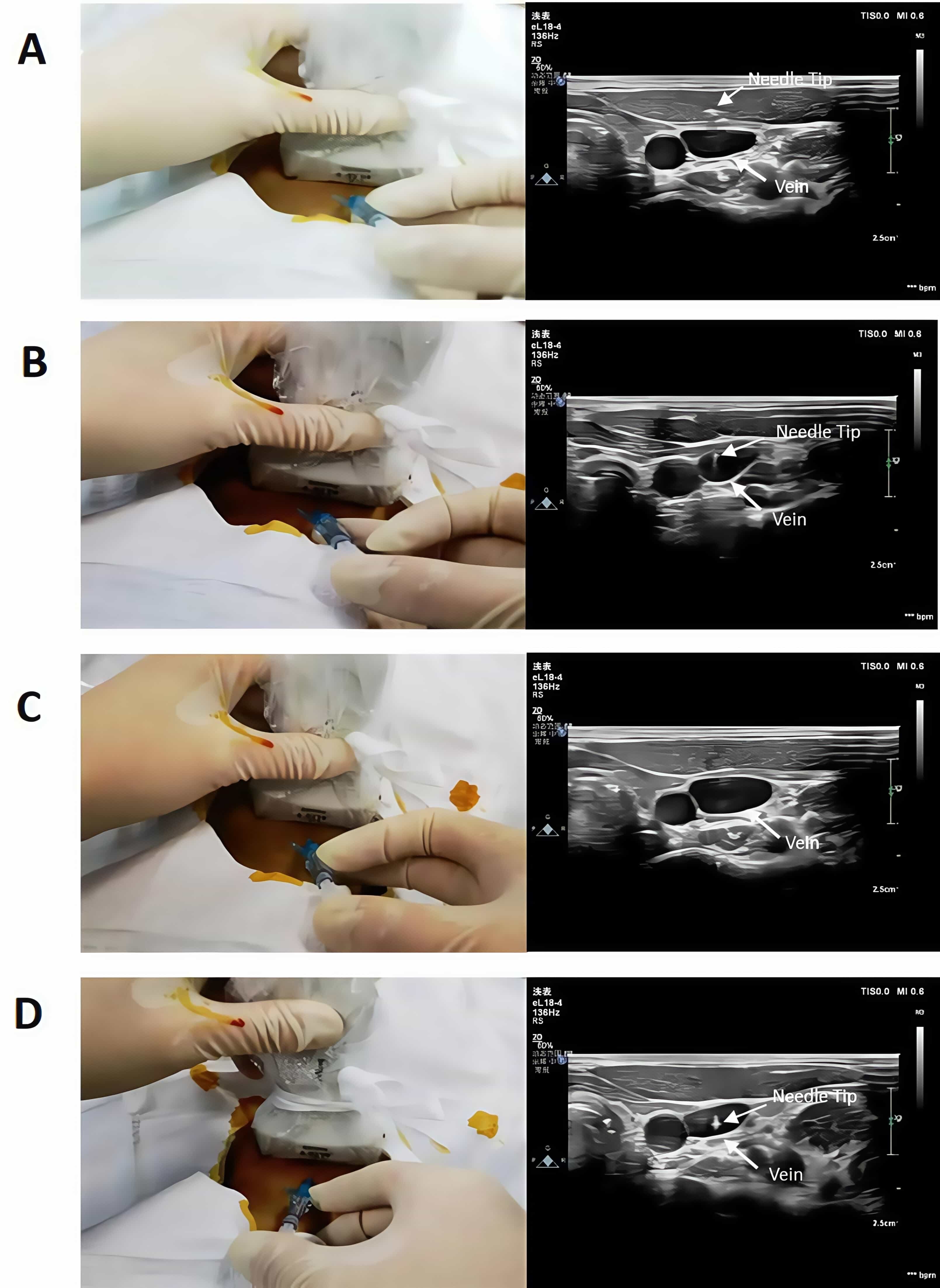 Procedure for ultrasound-guided internal jugular vein
cannulation in infants using the modified dynamic needle tip positioning method.
(A) The puncture needle is inserted at the contact point between the midpoint of
the ultrasound probe and the skin, with the needle tip appearing as a highly
reflective bright spot on the ultrasound image. (B) The needle is directed toward
the center of the vein, where the needle tip appears as a hyperechoic bright spot
on the ultrasound image. (C) Once the needle becomes visible, the ultrasound
probe is advanced forward and gently positioned alongside the needle. When the
needle reappears on the ultrasound image, the probe is moved proximally to allow
real-time tracking of the needle as it passes through the subcutaneous tissue and
cervical fascia, and ultimately penetrates the anterior wall of the internal
jugular vein. (D) This process was repeated to ensure complete insertion of both
the needle and catheter into the vessel.