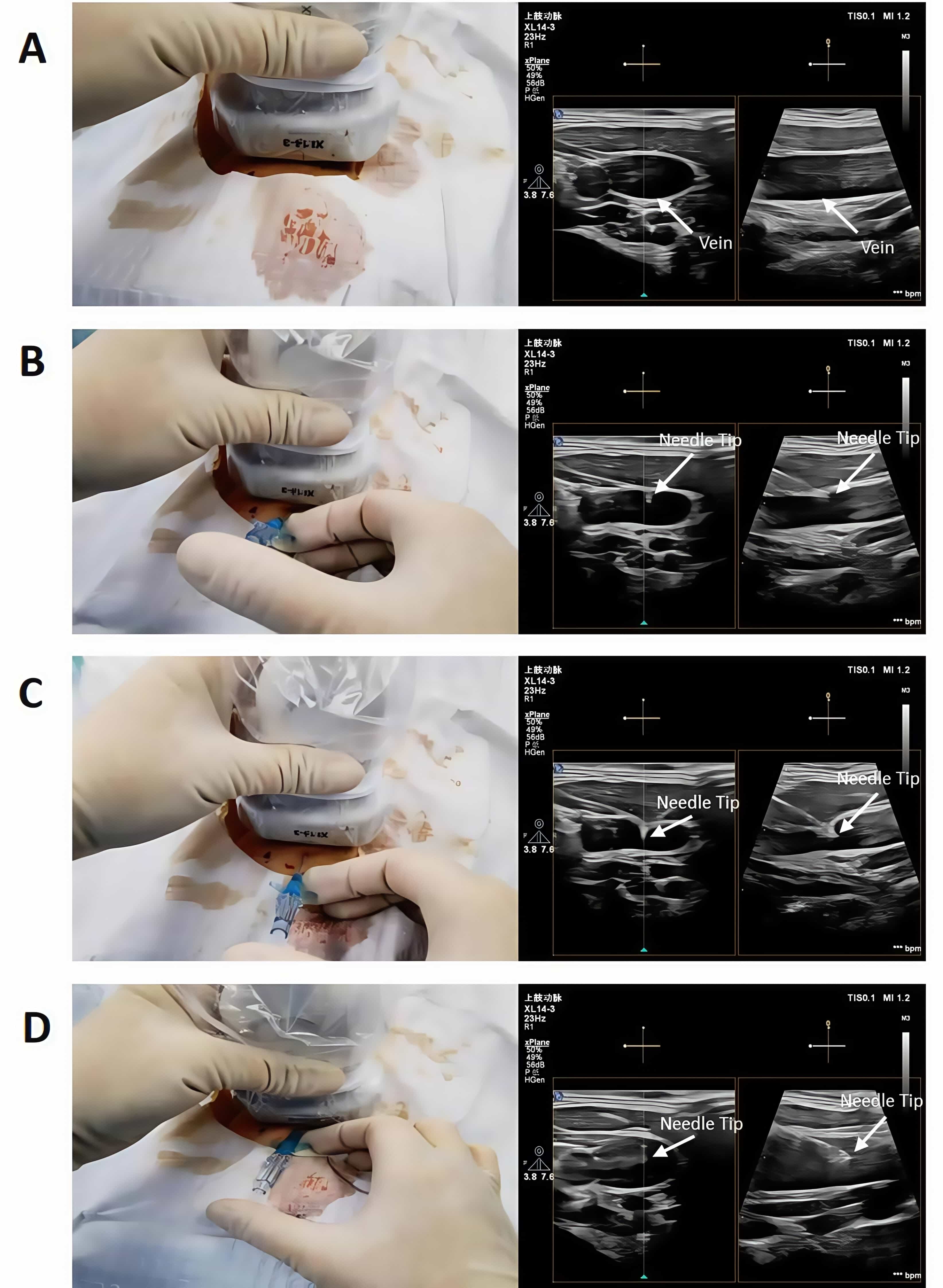 Procedure for ultrasound-guided internal jugular vein
cannulation in infants using the real-time biplane method. (A) The biplane
ultrasound probe is placed perpendicular to the long axis of the internal jugular
vein, allowing the vein to be simultaneously visualized at the center of both
ultrasound images in the long-axis in-plane and short-axis out-of-plane views.
(B) The puncture needle is inserted below the midpoint of the probe’s long axis.
Once the needle appears in both ultrasound images, its direction is adjusted
based on its position relative to the vessel, ensuring it is guided close to the
anterior wall of the vein. (C) The direction of needle advancement is
continuously adjusted using both the long-axis in-plane and short-axis
out-of-plane images, with the needle kept oriented toward the center of the
vessel. (D) This process was repeated to enable complete insertion of both the
needle and the catheter into the vessel under dual-plane ultrasound guidance.