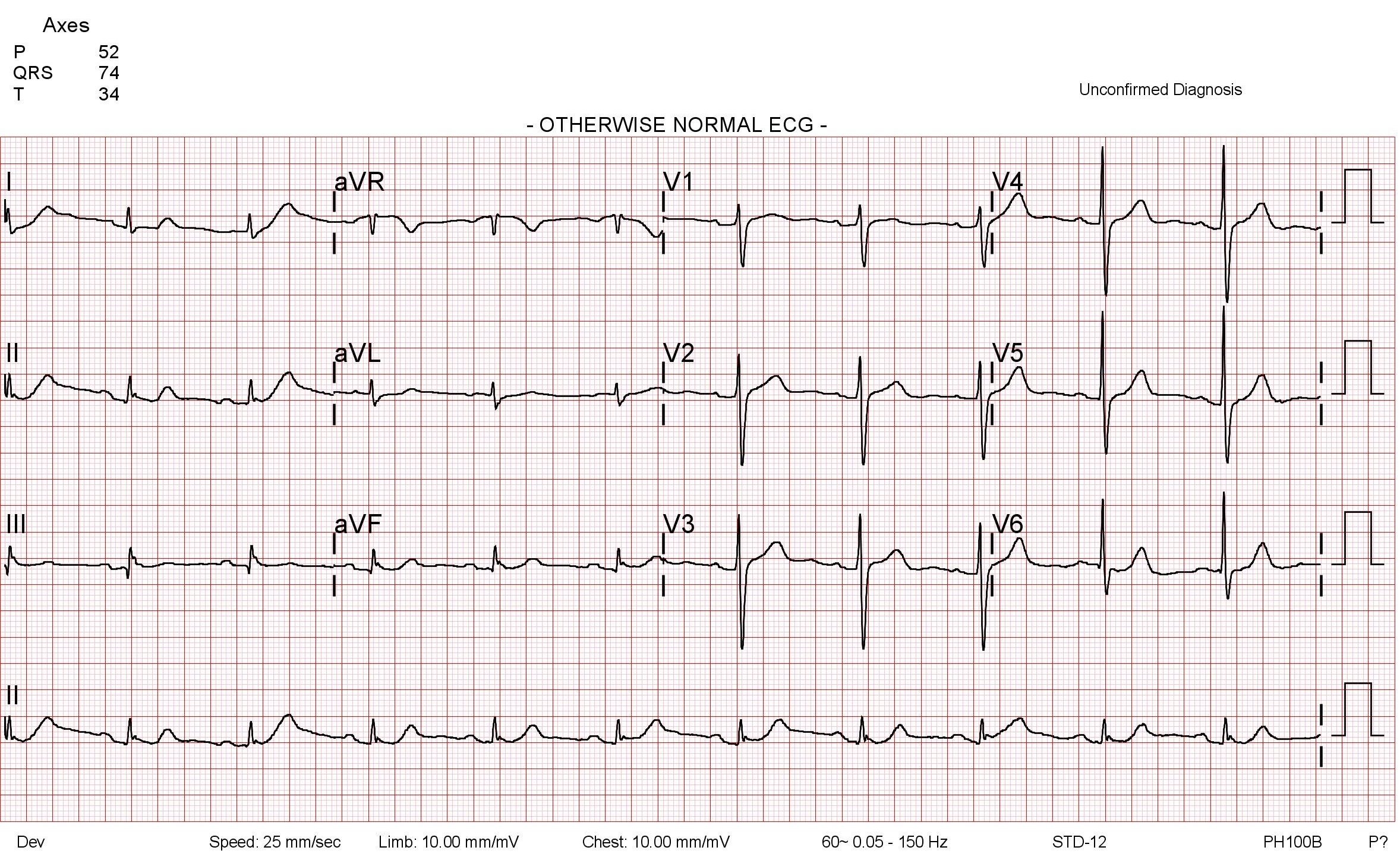 Initial electrocardiographic findings. The initial 12-lead
electrocardiogram showed a normal sinus rhythm with no ischemic or arrhythmic
changes. P, P wave; QRS, QRS complex; T, T wave; aVR, augmented Vector Right
(lead aVR); aVL, augmented Vector Left (lead aVL); aVF, augmented Vector Foot
(lead aVF); ECG, electrocardiogram; STD, ST-segment depression.