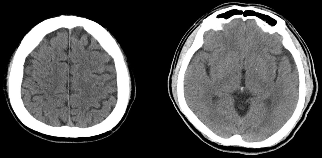 Initial brain CT findings. Brain CT image obtained upon
presentation showing no evidence of intracranial hemorrhage or acute infarction.