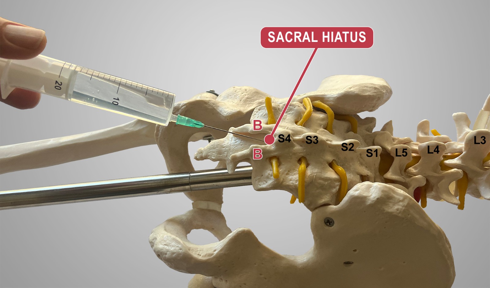 Demonstration of the caudal epidural injection (CEI) technique
on a skeletal model. The needle is shown entering the sacral canal through the
sacral hiatus (marked with a red circle). The sacral cornua are indicated by
letters B. Spinous processes of sacral (S4–S1) and lumbar vertebrae (L5–L3) are
labeled. Original figure created by the authors.