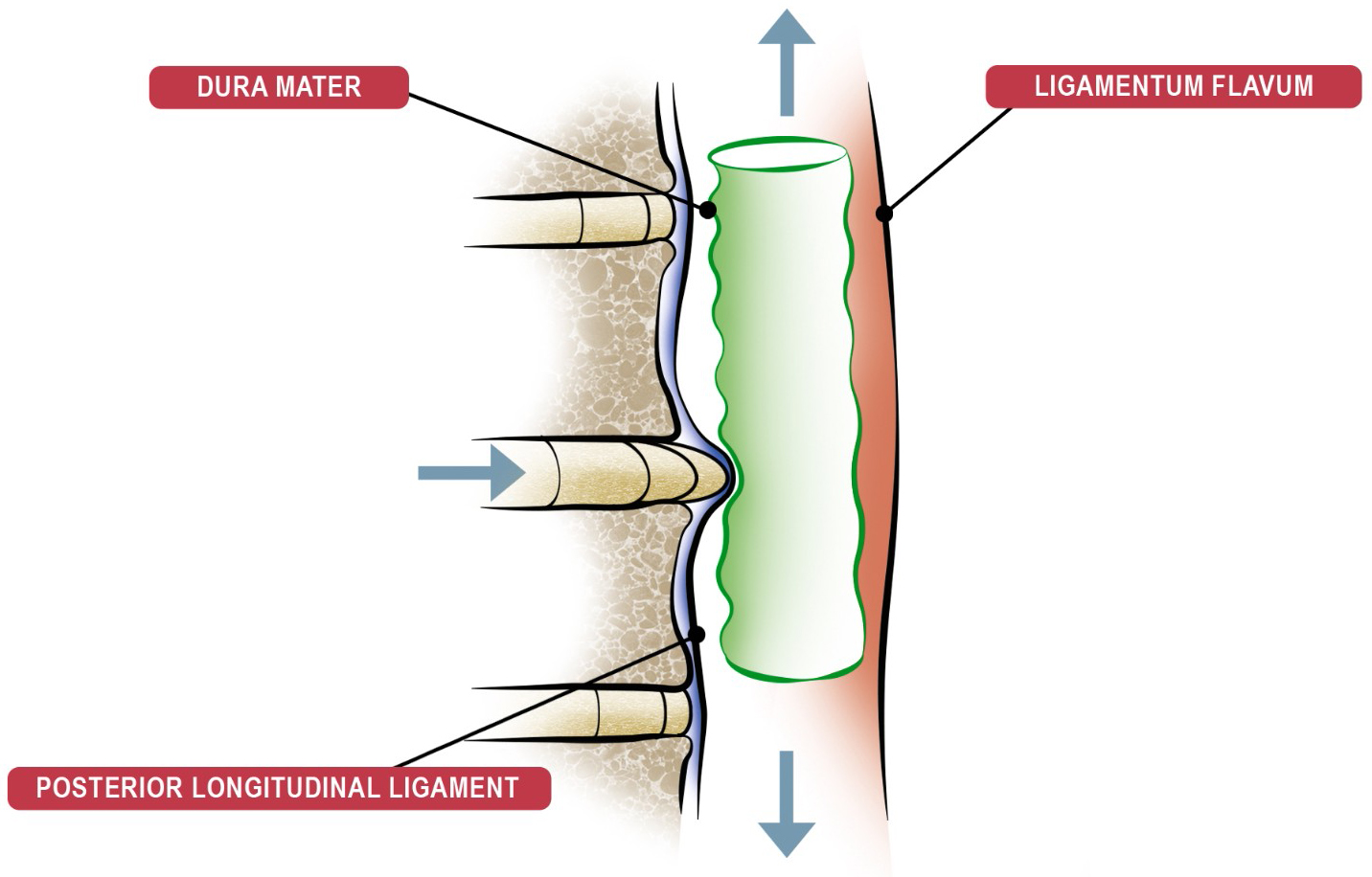 Protruded intervertebral disc in the sagittal section that has
moved posteriorly through the posterior longitudinal ligament, pressing against
the ventral side of the dura mater. Ligamentum flavum is also visible, which is
the posterior barrier of the intervertebral canal and epidural space. Original
figure created by the authors.