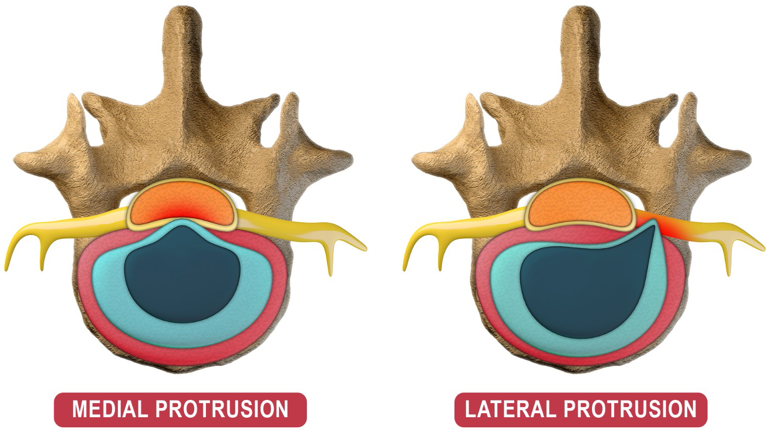 Displays two cases of disc protrusion viewed in the transverse
section. The left image shows a medial disc protrusion pressing on the middle
part of the dura mater, while the right image depicts a lateral disc protrusion
pressing on a nerve root. Original figure created by the authors.