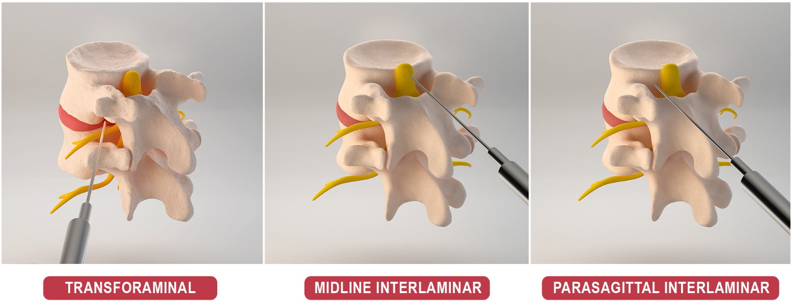 Illustrates three types of other epidural techniques and the
path of the needle for each. The far-left image shows the transforaminal
epidural, the middle image depicts the midline interlaminar, and the far-right
image represents the parasagittal interlaminar approach. Original figure created
by the authors.