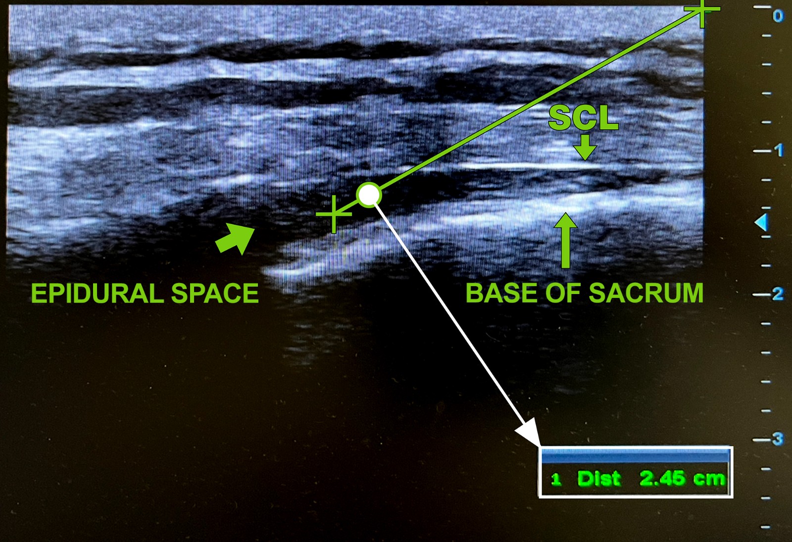Ultrasound image of the sacral hiatus. The epidural space, the
base of the sacrum, and the sacrococcygeal ligament are marked. The measurement
shows the distance from the apex of the hiatus to the entry point into the
epidural space, which is 2.45 cm. The measurement was obtained using calipers on
the ultrasound machine. Original figure created by the authors. SCL: sacrococcygeal ligament.